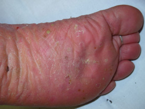 Pustulosis plantar