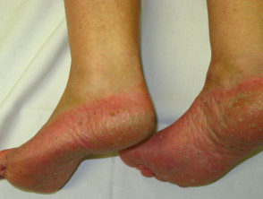 Pustulosis plantar