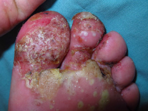 Plantarpustulose