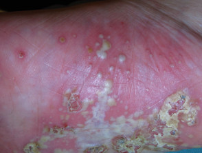 Pustulosis plantar