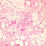 pleomorphic-lipoma-figure-1__protectwyjqcm90zwn0il0_focusfillwzi5ncwymjisingildfd-5270040-5234979-jpg-9269974