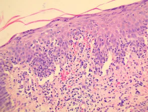 Pathologie der Pityriasis lichenoides und Varioliformis acuta (PLEVA)