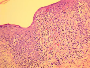 Pathologie der Pityriasis lichenoides und Varioliformis acuta (PLEVA)