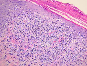 Pathologie der Pityriasis lichenoides und Varioliformis acuta (PLEVA)