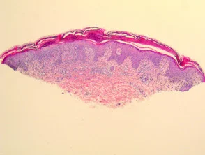 Pathologie der Pityriasis lichenoides und Varioliformis acuta (PLEVA)