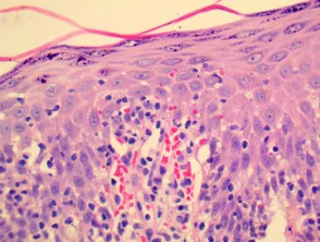 Pathologie der Pityriasis lichenoides und Varioliformis acuta (PLEVA)