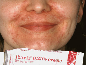 steroïde rosacea