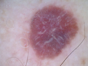 Vista de dermatoscopia polarizada de melanoma amelanótico nodular