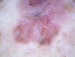 Dermatoscopia polarizada del carcinoma de células basales pigmentado