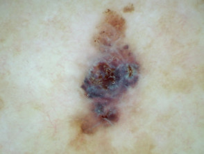 Dermatoscopia polarizada de melanoma