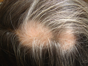 Poliosi nell'alopecia areata