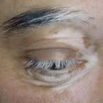 poliosis3__protectwyjqcm90zwn0il0_focusfillwzi5ncwymjisingildfd-1097231-8452173-jpg-6403416