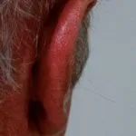 polychondritis1__protectwyjqcm90zwn0il0_focusfillwzi5ncwymjisinkildg1xq-9658389-3756876-jpg-8506338