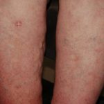 porokeratosis-context2__protectwyjqcm90zwn0il0_focusfillwzi5ncwymjisingildjd-6664199-6114420-jpg-4789362
