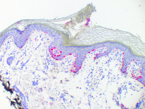 Poroqueratosis pigmentada (Melan A)
