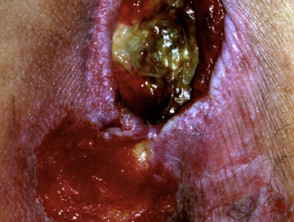 Úlcera