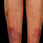pretibial-myxoedema-01__protectwyjqcm90zwn0il0_focusfillwzi5ncwymjisinkildewof0-2035101-7952390-jpg-1645064