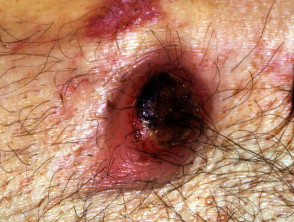 Linfoma anaplásico cutáneo primario de células grandes