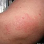 Progesteron-Dermatitis__protectwyjqcm90zwn0il0_focusfillwzi5ncwymjisingildfd-4360208-8899372-jpg-6475296