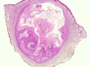 proliferating-epidermoid-cyst-figure-1__protectwyjqcm90zwn0il0_focusfillwzi5ncwymjisinkilde2xq-2349142-2654478-jpg-4368268