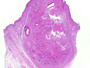 proliferierende-trichilemmale-Zysten-Figur-1__protectwyjqcm90zwn0il0_focusfillwzi5ncwymjisinkilduzxq-5159599-2339875-jpg-1052741