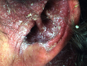 Oído de psoriasis