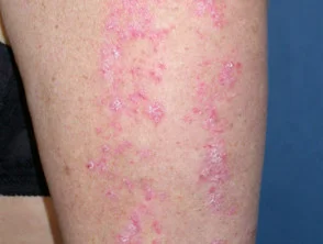 Psoriasis lineal siguiendo las líneas de Blaschko