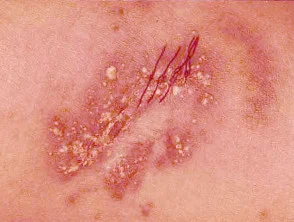 pustuleuze psoriasis