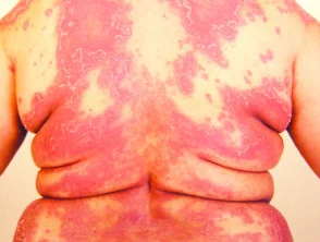 pustuleuze psoriasis