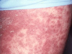 pustuleuze psoriasis