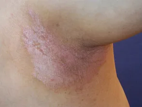 Psoriasis flexural