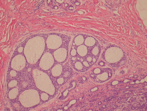 Patología del carcinoma polimorfo de glándulas sudoríparas