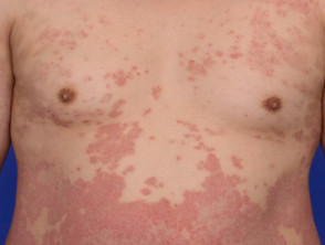 psoriasis pasi 094 v2