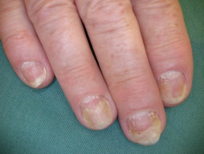 Psoriatische nageldystrofie