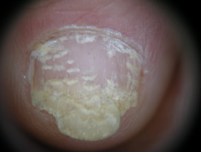 Psoriatische nageldystrofie