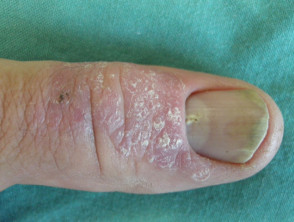 Psoriatische nageldystrofie