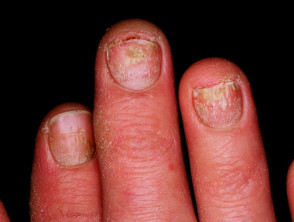 Distrofia psoriásica de las uñas