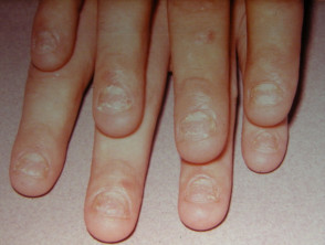 Distrofia psoriásica de las uñas