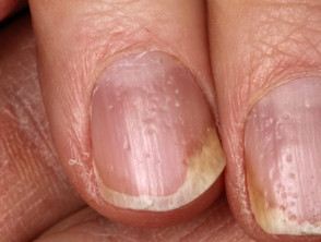 Psoriatische nageldystrofie