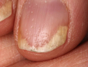 Psoriatische nageldystrofie