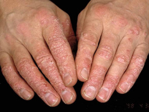 Psoriasis de manos