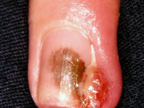 Granuloma piógeno, uñas