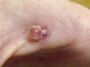 Granuloma piógeno de la mano