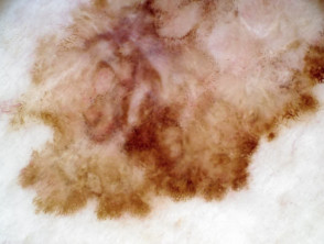Dermatoscopia de melanoma de extensión superficial de 0,4 mm de espesor