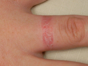 Dermatitis alérgica de contacto de las manos.