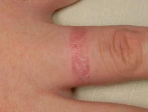 Allergische contactdermatitis van de handen.