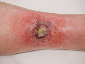 Dermatitis aguda por radiación