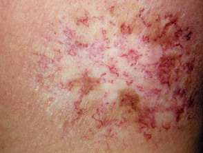 Dermatitis crónica por radiación