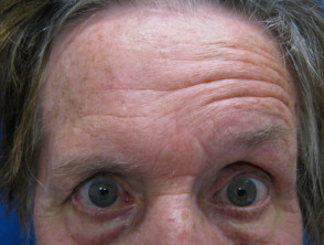 Síndrome de Ramsay Hunt: parálisis facial