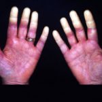 raynaud1__protectwyjqcm90zwn0il0_focusfillwzi5ncwymjisingildfd-4961403-3403669-jpg-9186648